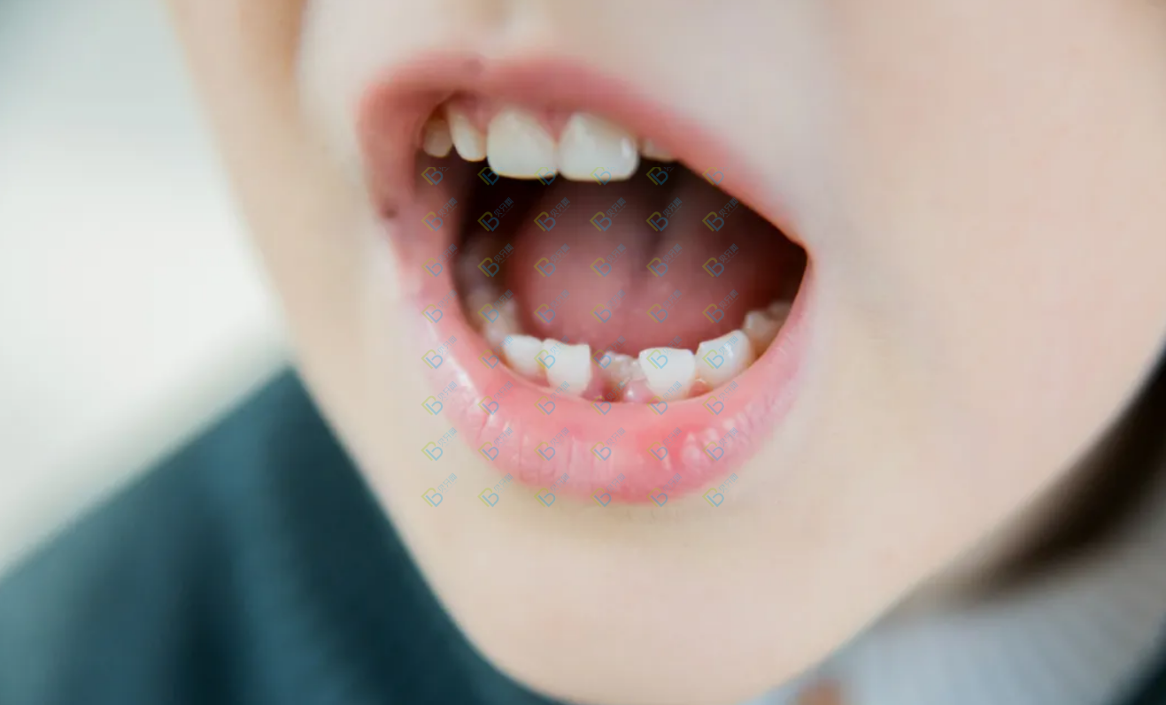 孩子好好的乳牙怎么越长越歪了呢？