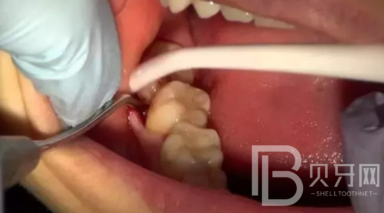 为什么牙医建议让拔掉智齿？