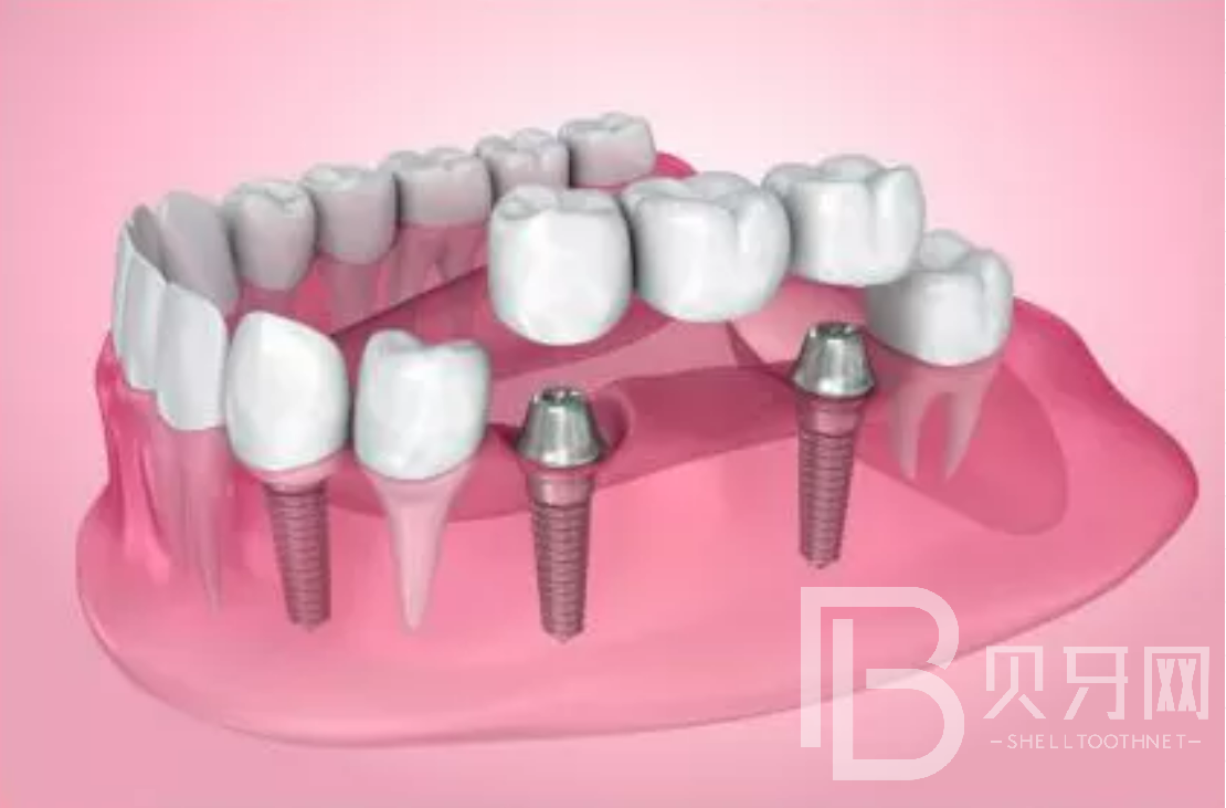 拔牙后一般多久能做种植牙？选什么植体比较好？