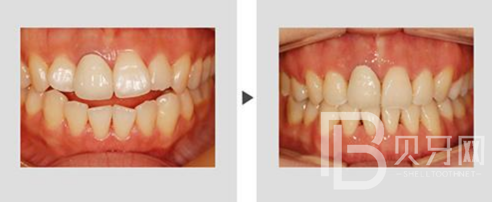牙齿不齐一定要矫正吗？还有哪些方式可以改变？