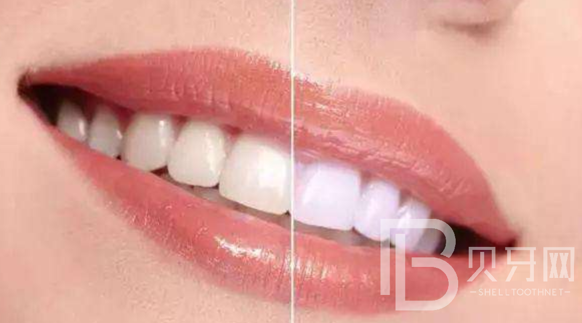 影响牙齿美白的六大食物,你知道是哪六种吗?