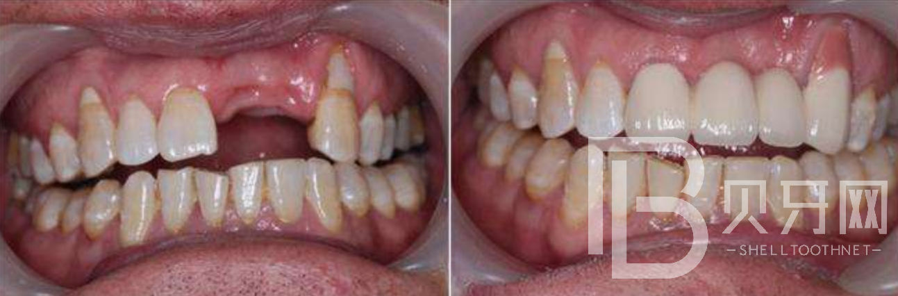 有牙周炎能不能做种植牙？