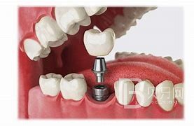 什么情况可以做种植牙?