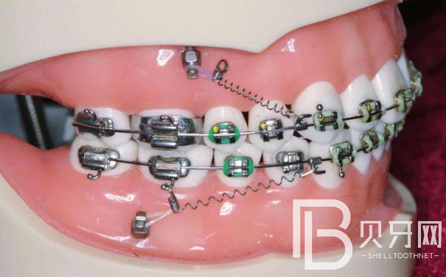 牙齿矫正多久才会有效果？牙齿矫正需要多长时间