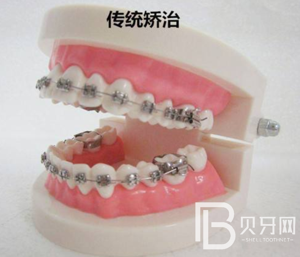 牙齿矫正需要多久，流程是什么样的？