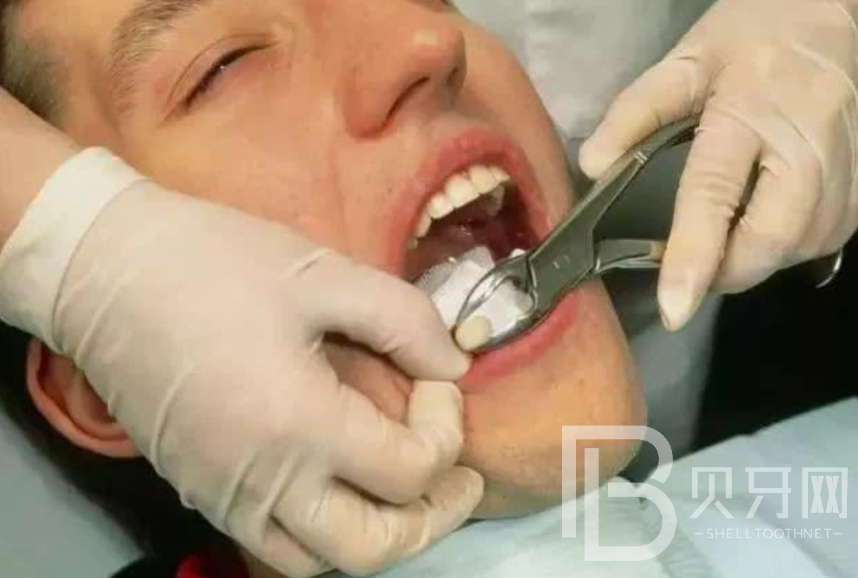 拔牙的注意事项有哪些，这几个你一定要知道