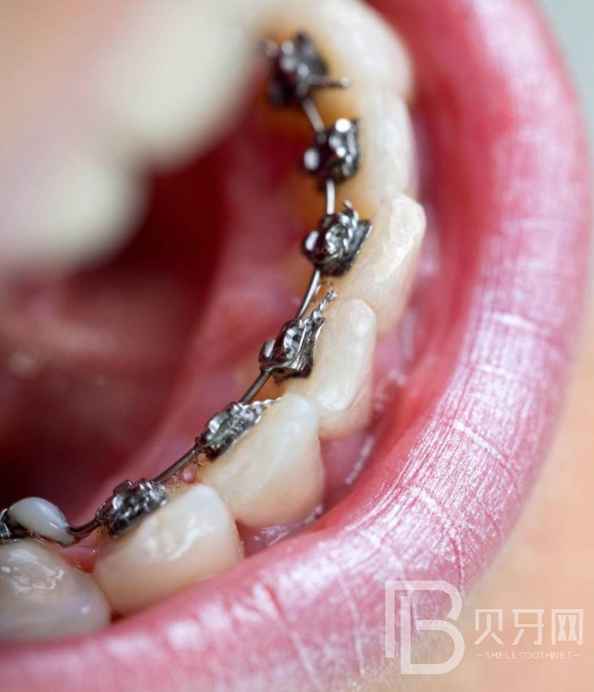 牙齿矫正后要注意什么？听听牙医怎么说