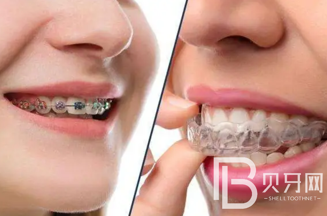 金属矫正和隐形矫正应该怎么选择