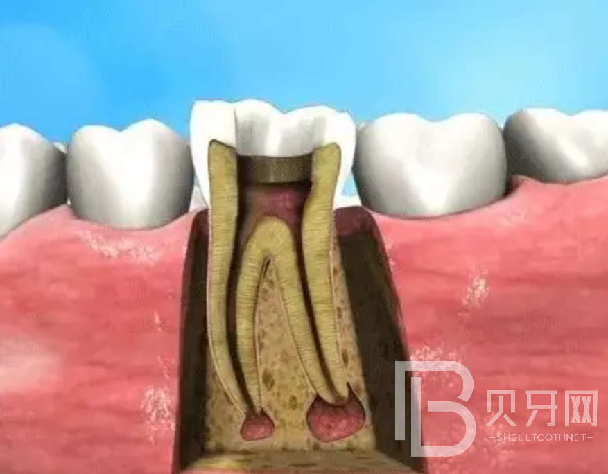 补牙和根管治疗有什么区别？