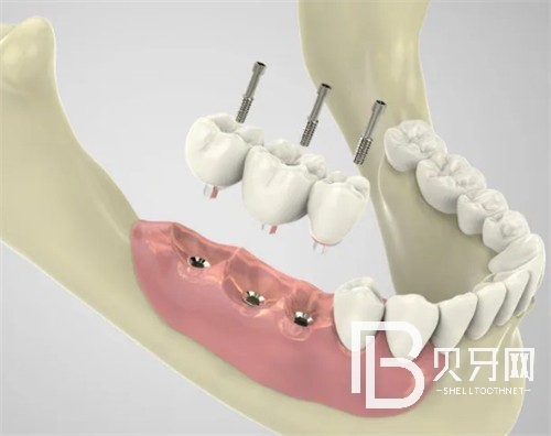 北京中诺口腔医院种植牙怎么样?价格贵不贵?
