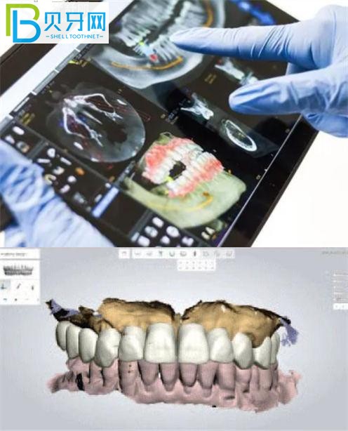 美奥口腔种植牙技术怎么样 徐州的单颗半口都多少钱?