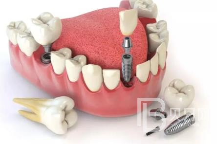 广州拜博口腔口碑好不好?靠谱吗?广州拜博口腔种植牙多少钱