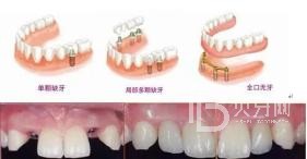 60岁的人种植牙还是镶牙好?北京冠美口腔怎么样?