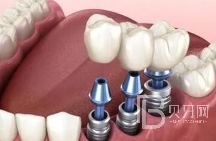 广州诺尔口腔怎么样?广州诺尔口腔种植牙一颗多少钱