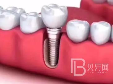 广州研科口腔医院怎么样？广州研科口腔口碑好不好？广州研科口腔种植牙多少钱