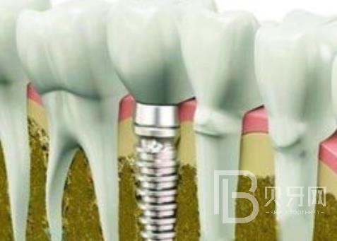 广州固美口腔怎么样？广州固美口腔种植牙一颗多少钱