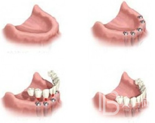 全口种植牙是种几颗？北京科瓦口腔医院怎么样？