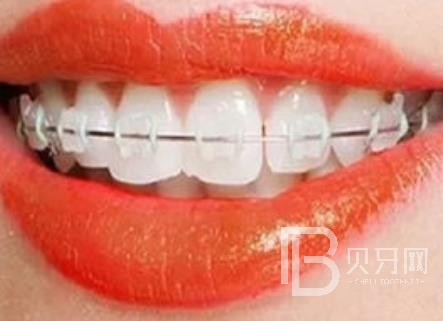 广州爱顿口腔怎么样?广州爱顿口腔口碑好不好?广州爱顿口腔种植牙价格