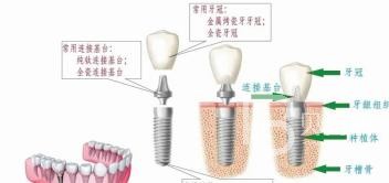 70岁的老人骨量不足还能做种植牙吗？北京海德堡口腔怎么样？