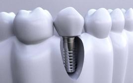 大门牙种植牙要多少钱？北京种植牙医院排行榜前10名！