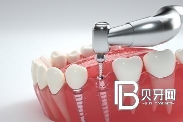 北京做种植牙修复大概多少钱一颗？北京国医康口腔门诊部怎么样？