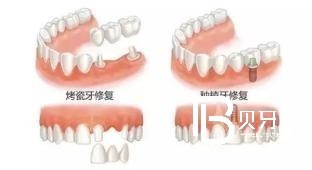 北京半口牙齿缺失的治疗方法有哪些？北京优贝口腔(怀柔店)怎么样？