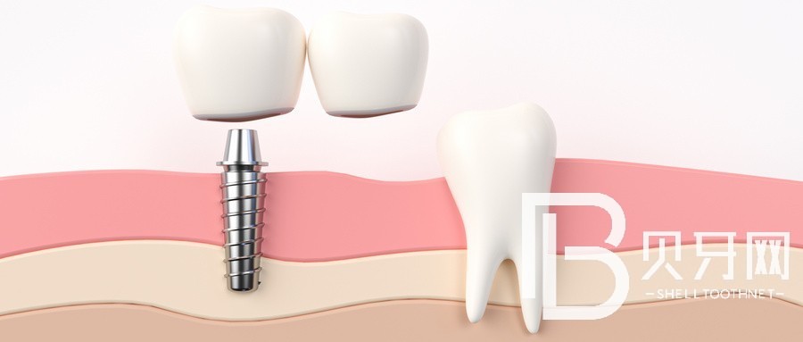 北京即刻种植牙和普通种植牙的区别？北京薇琳医美口腔中心怎么样？