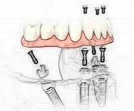 东莞好佰年口腔all on-4种植牙怎么样？